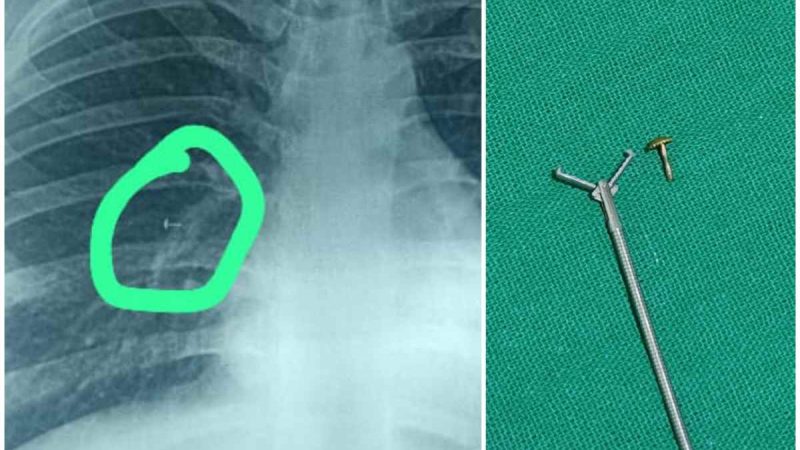 मेडिका सुपरस्पेशलिटी हॉस्पिटल में एक महिला के फेफड़े से निकाला गया घातक नोज़ पिन स्क्रू
